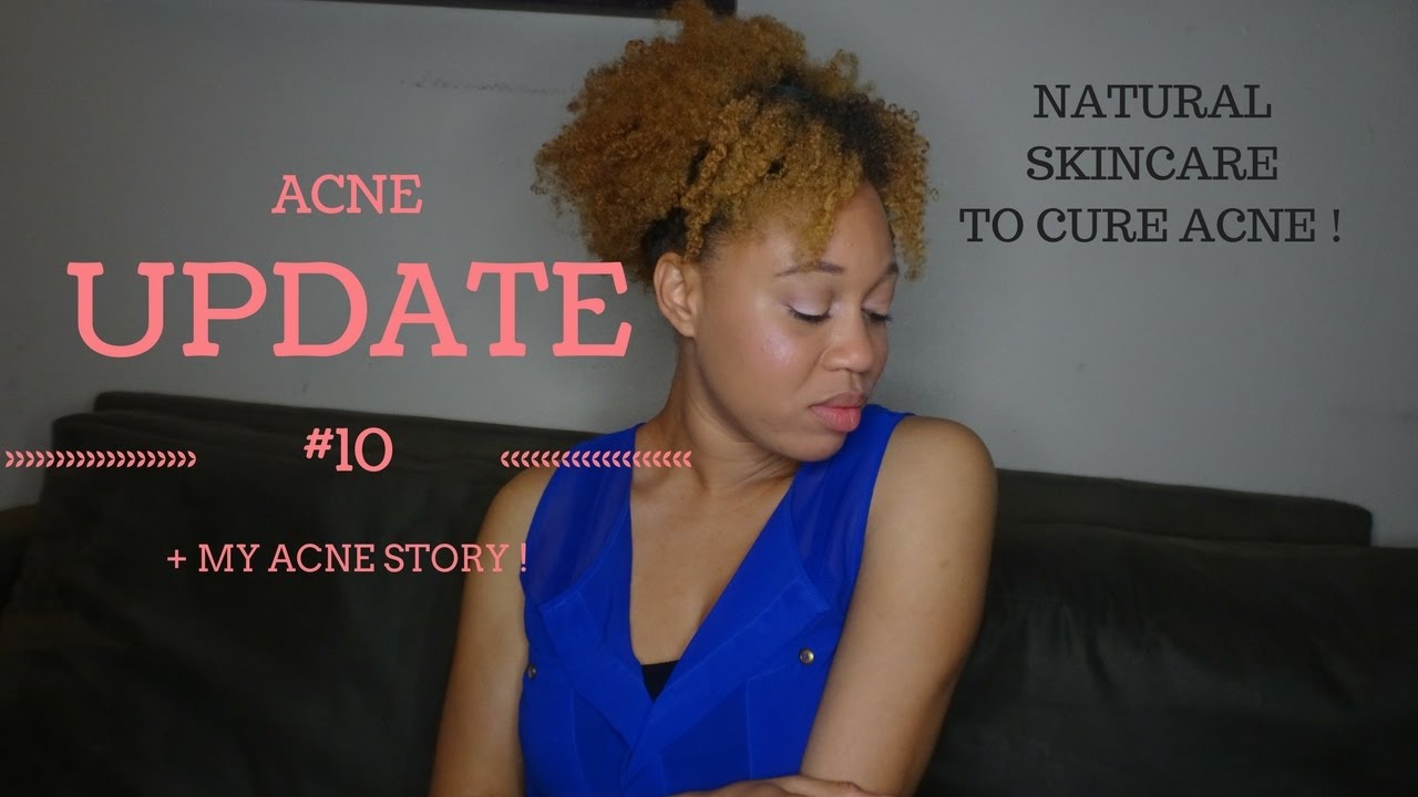 ACNE UPDATE # 10 How I Keep my Skin Clear (Skin Care) + MY ACNE STORY ...
