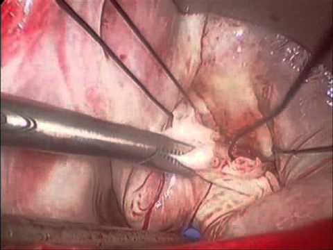 Minimally Invasive Mitral Valve Repair, with Pre & Post-Op Echo Results