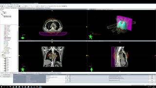 Right Lung & esophagus planning. iMRT Eclipse 16. TrueBeam