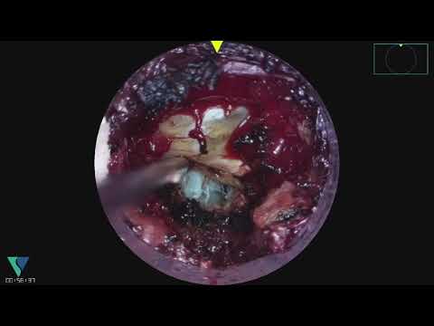 Surgical Video of TLIF Procedure Using Viseon MaxView System - video from Viseon