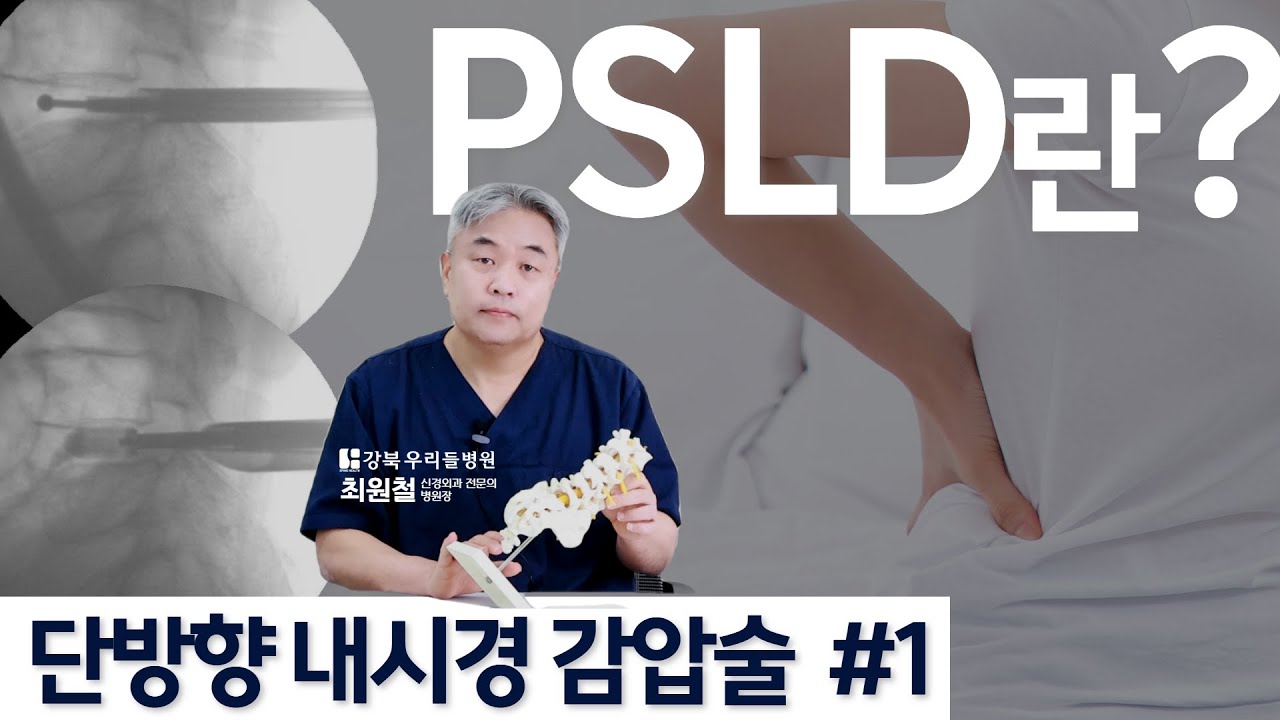 더 안전하고 효과 좋은 척추 내시경 수술은 뭘까요? 단방향 내시경 감압술 PSLD에 대해 최원철 원장님께서 알려드립니다 ...