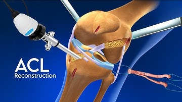 ACL Reconstruction 3d Animation Surgery | Hamstring Method Arthroscopic Acl reconstruction
