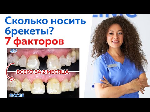 Сколько носить брекет-систему? / ТОП-7 факторов, определяющих срок ношения брекетов