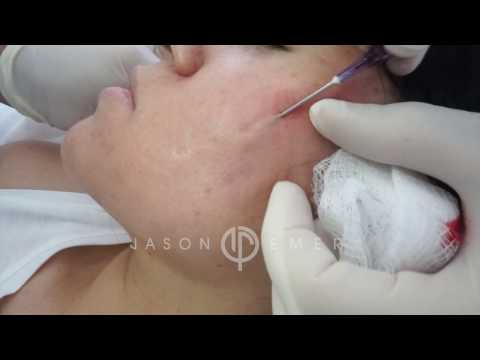 Subcision for Acne Scars | Acne Scar Treatment | Cheek Acne scar removal | Dr. Jason Emer