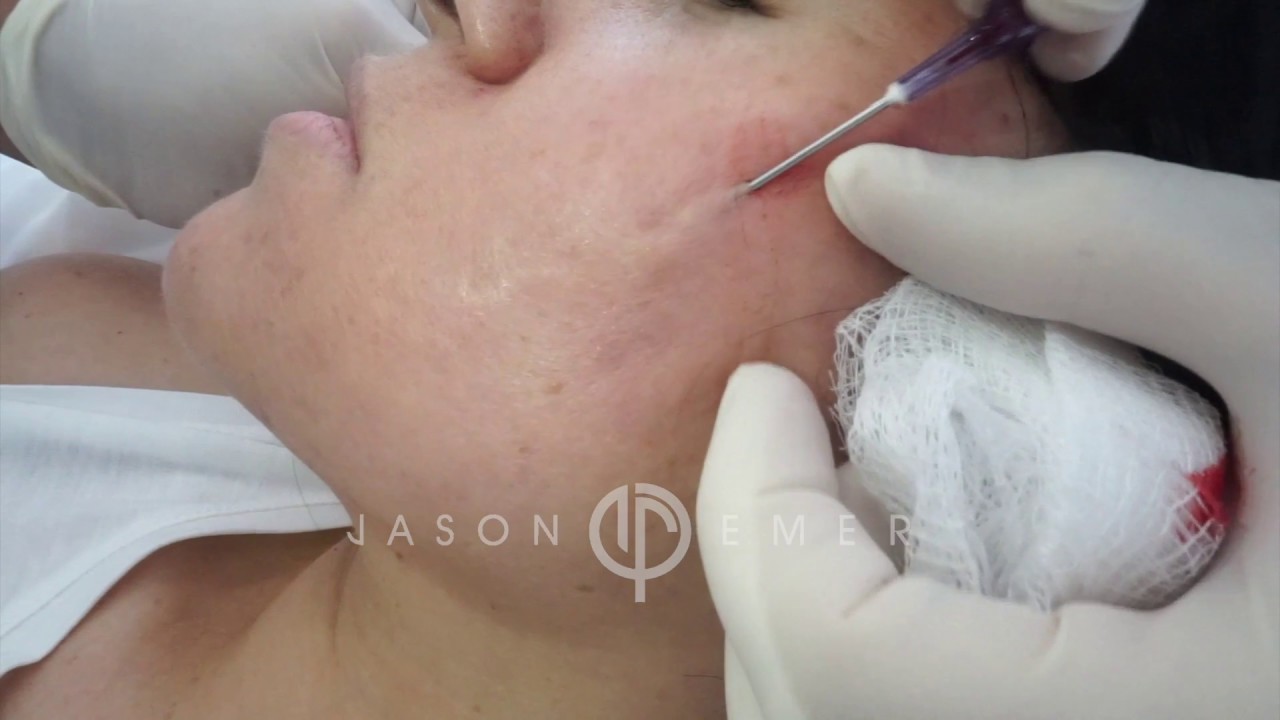 Dr jason emer acne scars