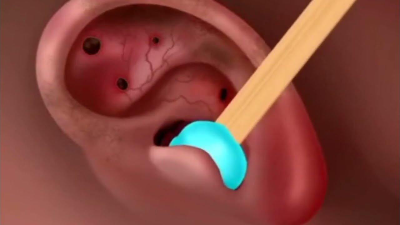 Ear cleaning asmr asmr infection treatment ear cleaning ear