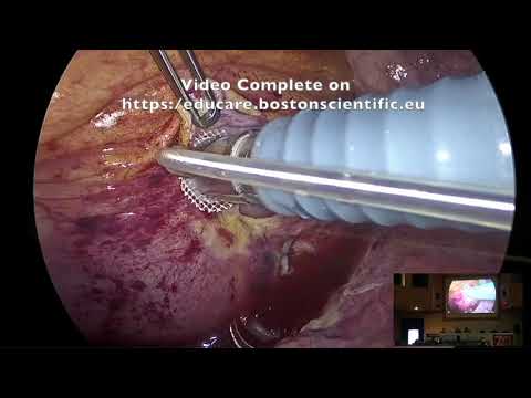 Minimally Invasive Epicardial Resynchronization  -  ASST Mantova Live Surgery - Andrea Droghetti
