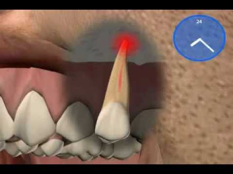 Video: Welcher Zahnarzt führt Wurzelbehandlungen durch?