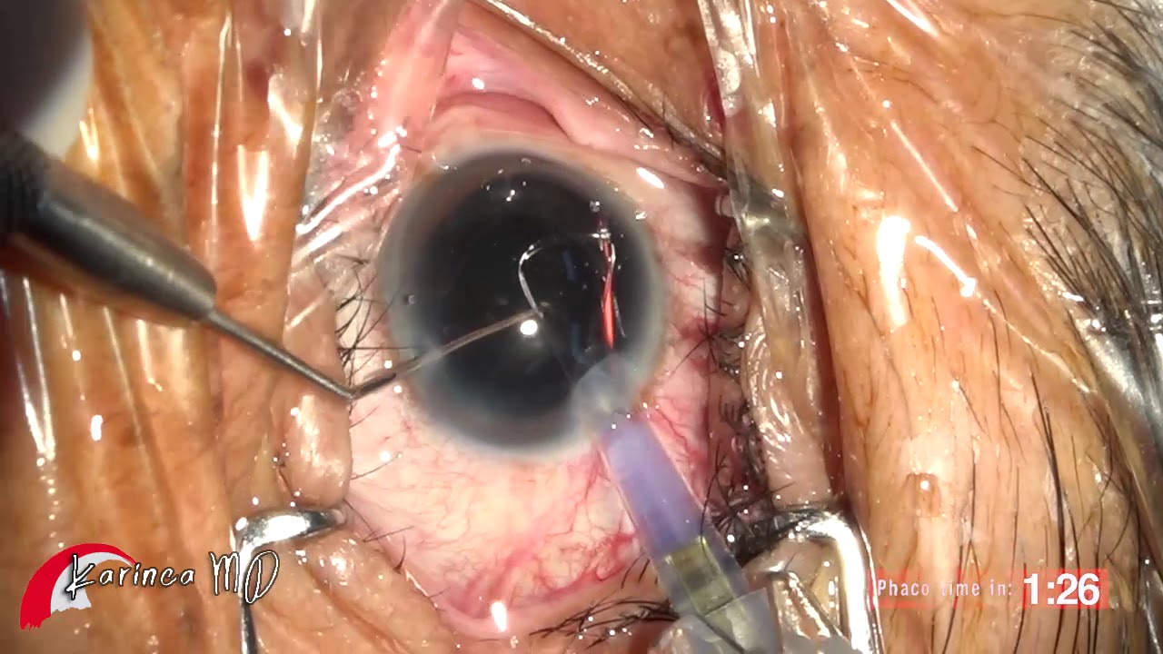 Besivance Eye Drops After Cataract Surgery evakrausdesign