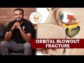 Orbital blowout fracture  dr sree charan