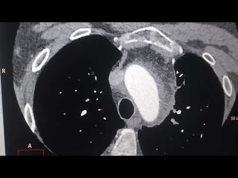 الفرق بين فحص الاورطي الصدري في الاشعه المقطعيه مع توصيل رسم القلب وبدون رسم القلب 