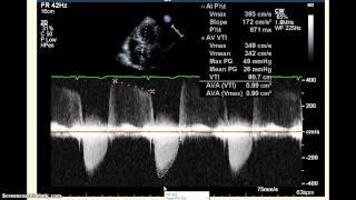 AccreditCoach:  Image Quality - Correct Doppler