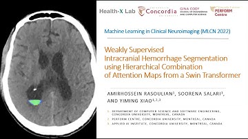 Weakly Supervised Intracranial Hemorrhage Segmentation by Hierarchical Combination of Attention Maps