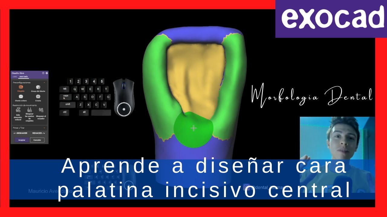 Exocad💥Aprende a diseñar cara palatina incisivo central sup.. Lograrás diseños ESTETICO-FUNCIONALES