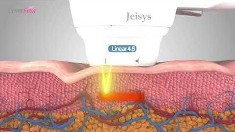 ULTRAcel Q+ linear-shot HIFU treatment (LinearFirm)