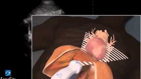3D Lehrvideo: EFAST - Subxiphoid