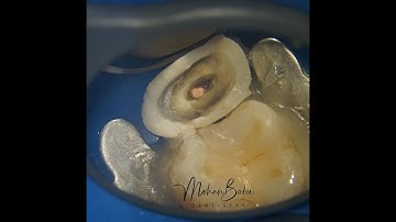 "MB Deep Margin Reverse Elevation Technique" - Novel Method for Extreme Deep Margins !