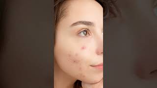 Remedy for Oily Skin, Acne Spots & Open Pores Solutions / Skin Care  Reviews & Remedies /