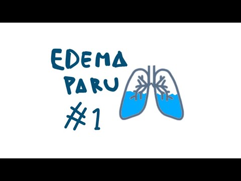 EDEMA PARU (1/3) PATOFISIOLOGI EDEMA