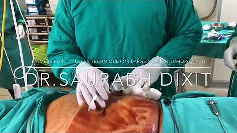 Palmer’s Point !!Laparoscopic Ovarian Cystectomy !!Veress Needle !!Safe Laparoscopy (Part 1)