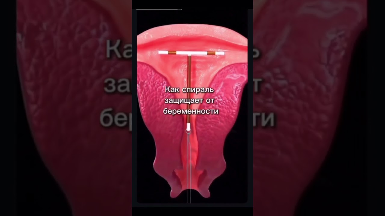 Как спираль защищает от беременности? #акушергинеколог #беременность #роды #спираль