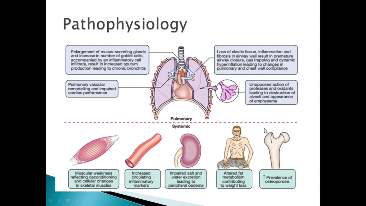 COPD by Dr Istikhar Ali Sajjad