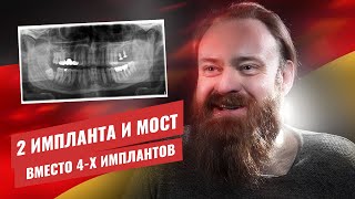 КЕЙС: установили 2 импланта и мост вместо 4-х имплантов 🇺🇦