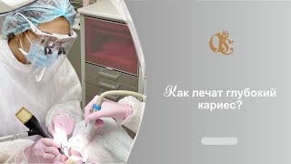 Как лечат глубокий кариес в Гильдии стоматологов? Лечение глубокого кариеса в Санкт-Петербурге