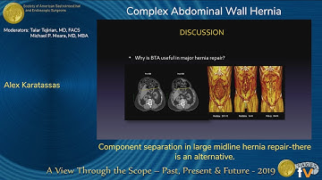 Component separation in large midline hernia repair-there is an alternative.