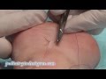 Basic suturing technique simple interrupted stitch