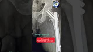 Pfn Proximal Femoral Nailing It Fracture Femur Neck Adamya Hospital Gadag