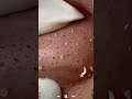 Skincare | Blackheads Removal #727 #tweezers skincare #blackheads blackheads