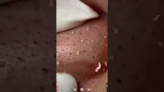 Skincare | Blackheads Removal #727 #tweezers skincare #blackheads blackheads