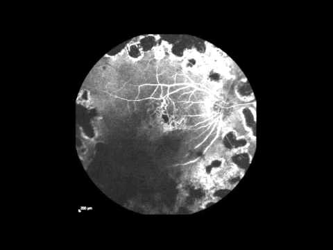 Real-Time Fluorescein Angiography