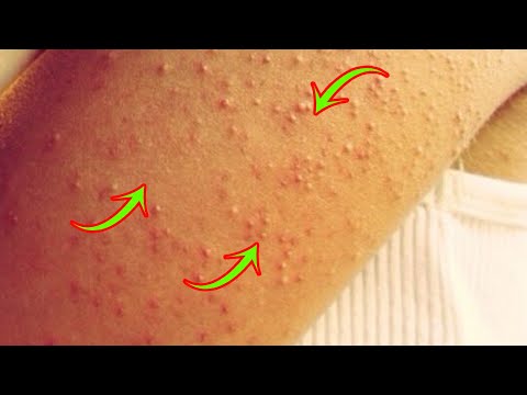 DO YOU HAVE THESE LITTLE BUMPS ON THE ARMS? SEE WHY THEY COME OUT AND HOW TO REMOVE THEM