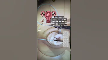 ربط عنق الرحم 