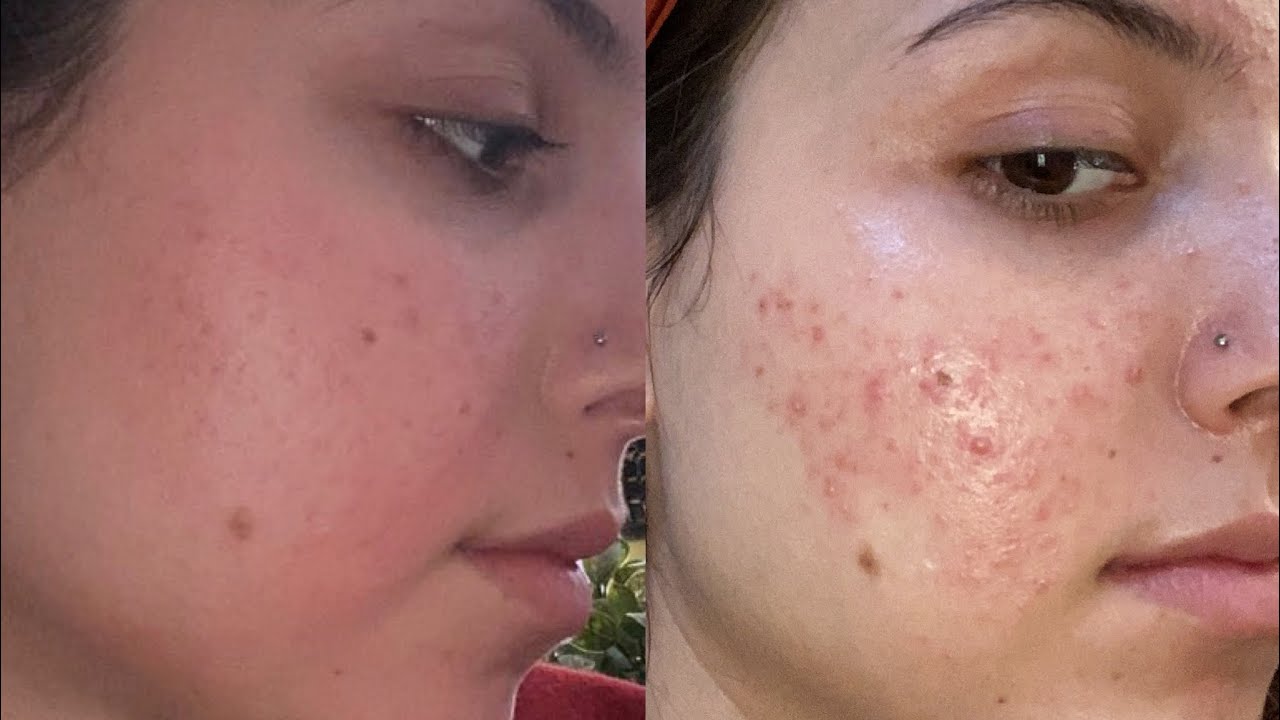 My acne journey and how I improved my skin (: - YouTube