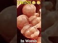 Twin Embryo and Fetal Development In Mother's Womb! Twins Pregnancy! Fetus Growing 👶