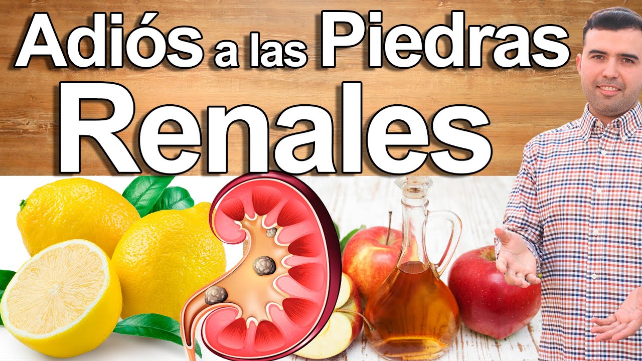 Como Eliminar Piedras o Calculos Renales - Piedras en Los Riñones Nunca ...