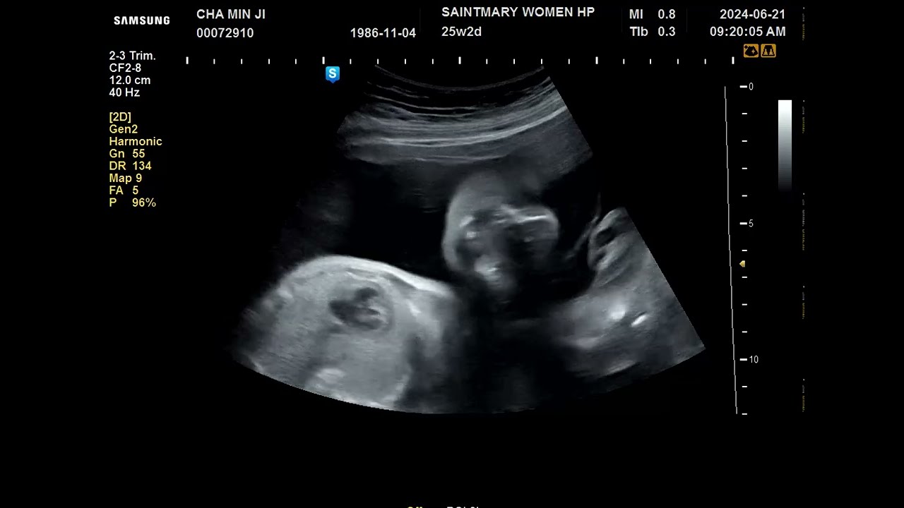 [24.06.21] 엄청나게 움직이던 앵두가 약간 덜 움직여서 걱정돼서 급 초음파보기