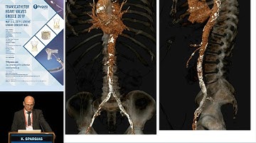 K. Spargias | How far should we push the borderline transfemoral access for TAVR?