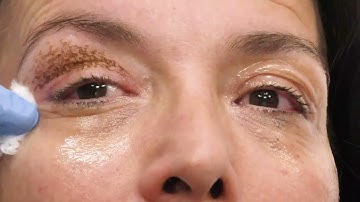 Non-Surgical Blepharoplasty / Plexr Plasma