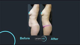 Tummy Tuck Mommy Makeover Procedure Overview