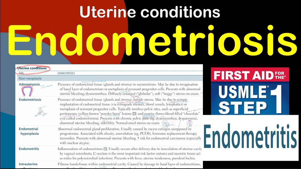 Endometriosis in Hindi/Urdu by first aid for USMLE step 1 - YouTube