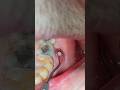 Tooth Abscess | Tooth infection #abscess #cyst#shortsfeed