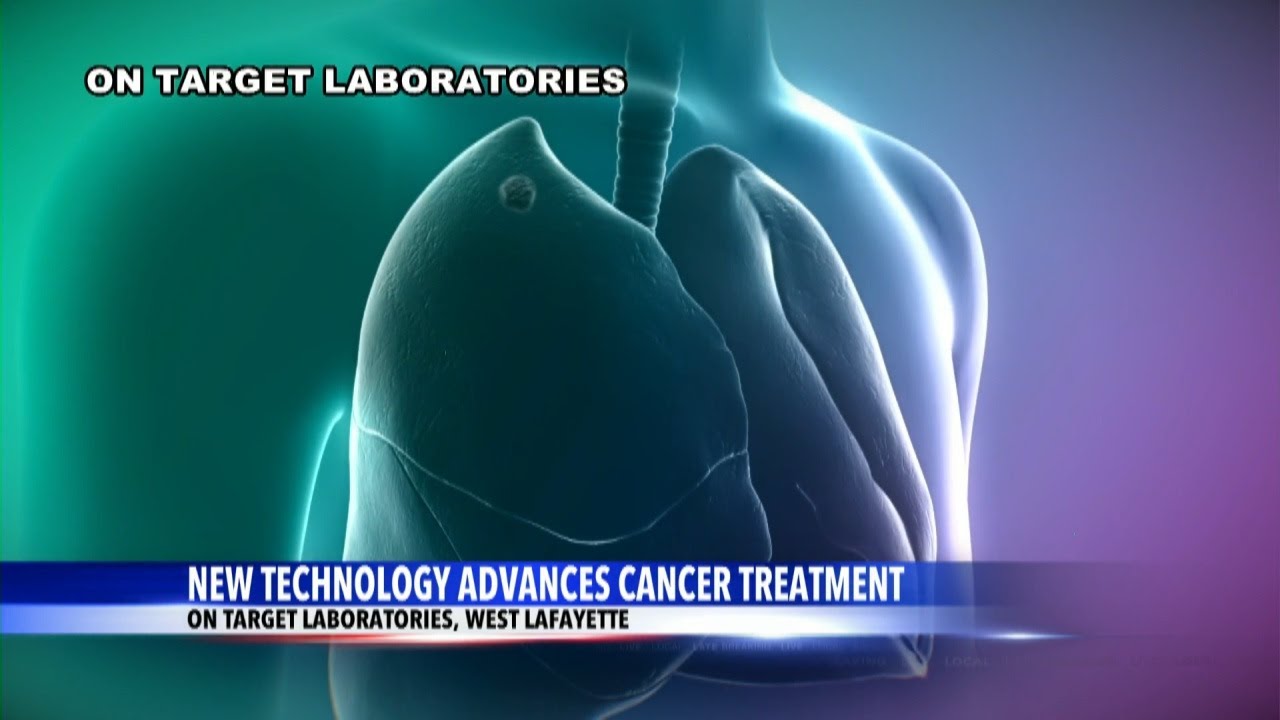 Three-time lung cancer survivor shares how new technology saved her life