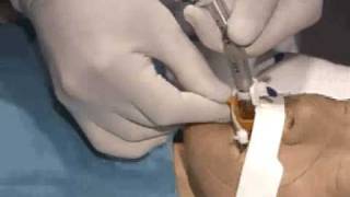 B&B Medical Technologies Universal Bite Block (Adult/Pediatric)