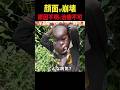 紛争地アフリカ・コンゴの子ども:原貫太が出会った原因不明の病気で顔が腫れあがるが治療できない現実。国境なき医師団が病院で検査を行うも…