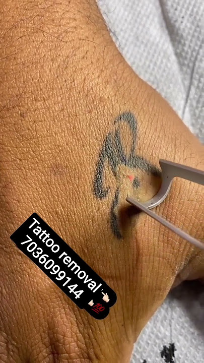 permanent tattoo removal best price Hyderabad