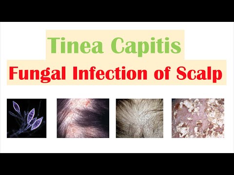 Wideo: Ringworm Of The Scalp (Tinea Capitis): Przyczyny, Objawy I Leczenie